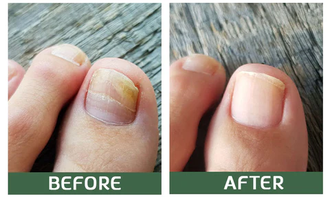 Furzero™ Toenail Fungus Rapid Repair Pen - Image 5