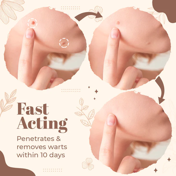 Derma’Pro Mole & Wart Removal Treatment Set - Image 7