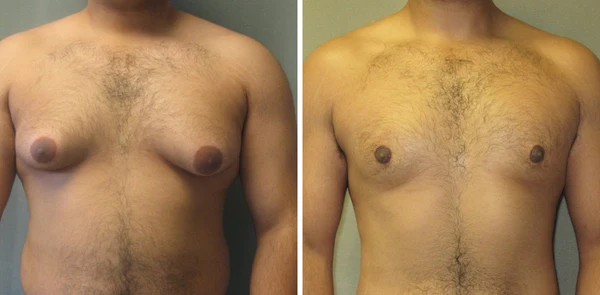 Luhaka™ Gynecomastia Cream – Chest Fat Burner - Image 5