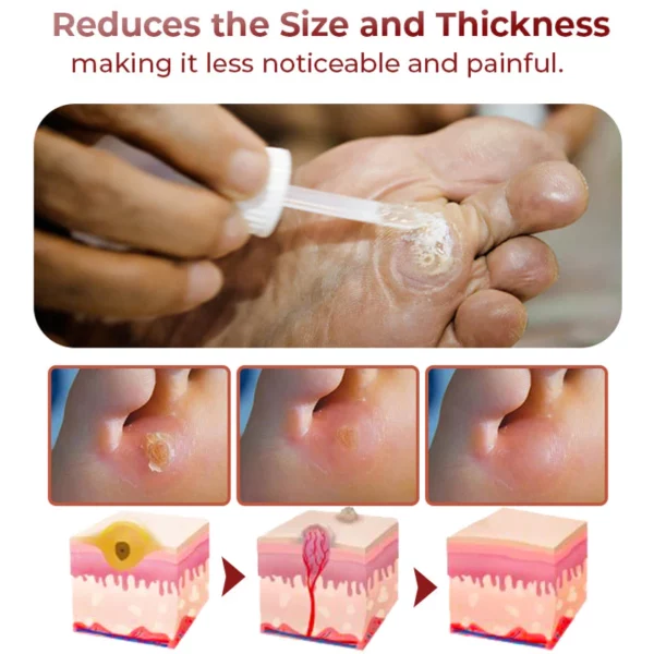 GFOUK™ Foot Corn Removal Extra Strengthen Gel - Image 7
