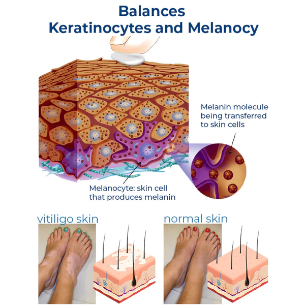 GFOUK™ Vitiligo-Therapie-Creme - Image 5