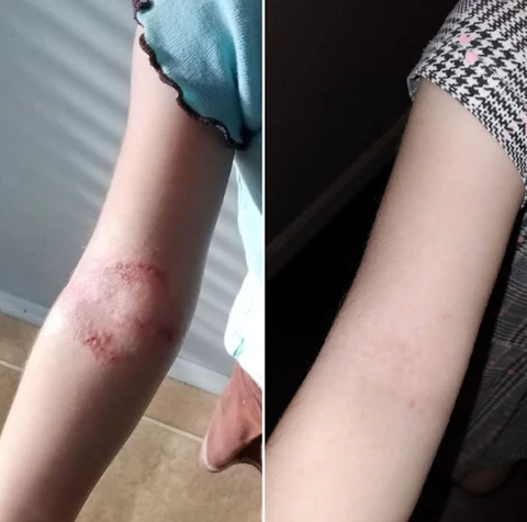 TineaCure™ Bio Corporis Cream - Image 7