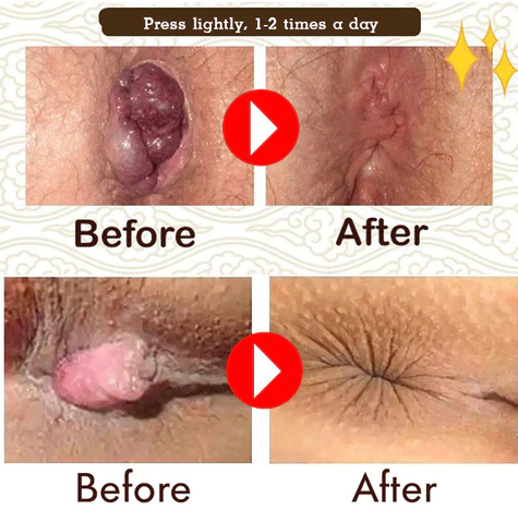 HealHem™ Herbal Hemorrhoids Anal Capsules - Image 4