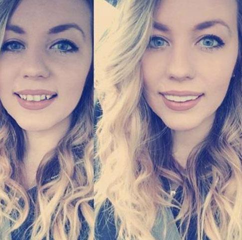 Instant Teeth Veneer - Image 4