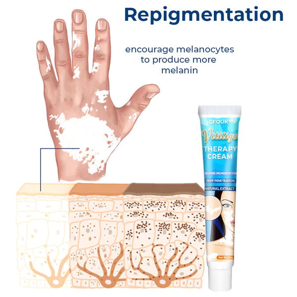 GFOUK™ Vitiligo-Therapie-Creme - Image 4