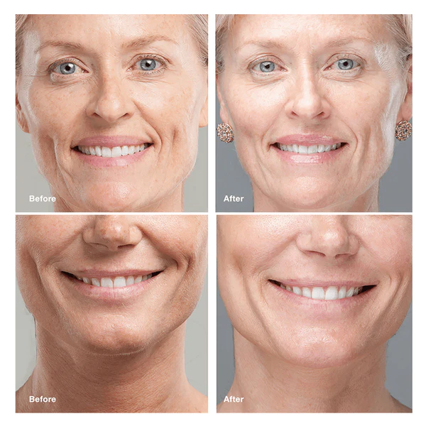 Korean Protein Lifting Threading Set - Image 7