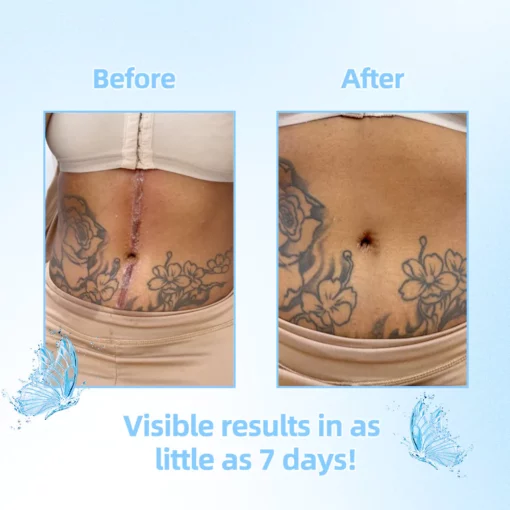 ScarFree™ Professional Advanced Cool Scar Treatment - Image 6