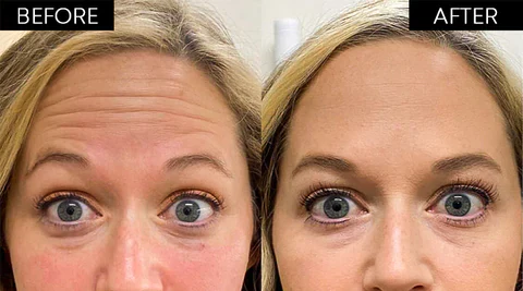 Korean Protein Lifting Threading Set - Image 8