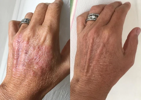 TineaCure™ Bio Corporis Cream - Image 6