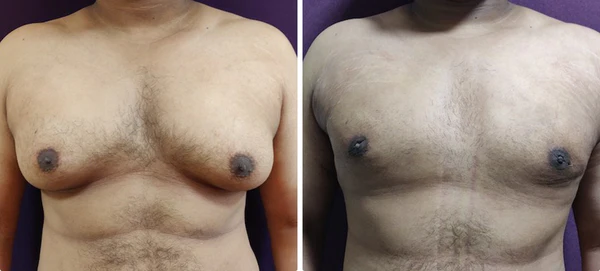 Luhaka™ Gynecomastia Cellulite Melting Spray - Image 7