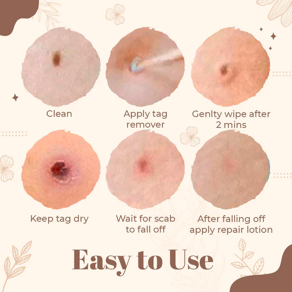 Derma’Pro Mole & Wart Removal Treatment Set - Image 5