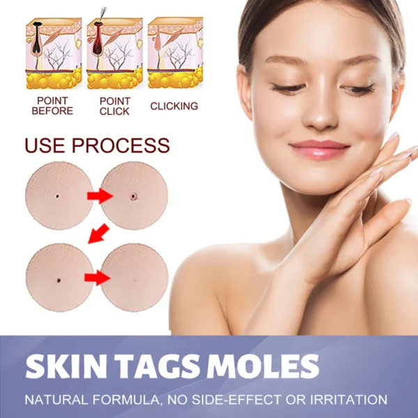 OUHOE™ Tags & Moles Remover - Image 3