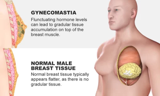 Luhaka™ Gynecomastia Cellulite Melting Spray - Image 4