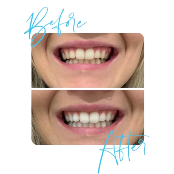 GLOSMILE™ Teeth Whitening Mousse - Image 5