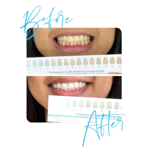 GLOSMILE™ Teeth Whitening Mousse - Image 4