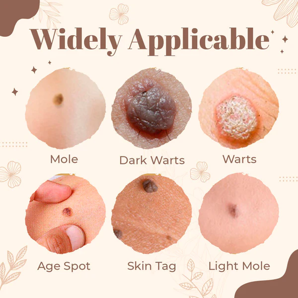 Derma’Pro Mole & Wart Removal Treatment Set - Image 9