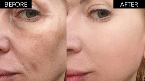 Korean Protein Lifting Threading Set - Image 6