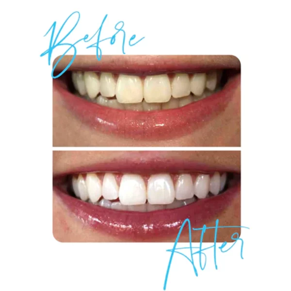 GLOSMILE™ Teeth Whitening Mousse - Image 3