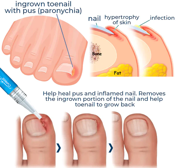 LEFUN Removal Paronychia Gel - Image 3