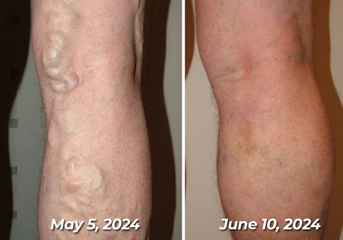 flysmus™ Varico-X Vein Dredge Bee Venom Spray - Image 3