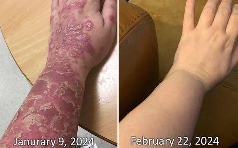 GFOUK™ PsoriX Bee Venom Cream - Image 8