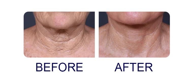 ODEIUN® CollagenFirming Lifting Neck Cream - Image 6
