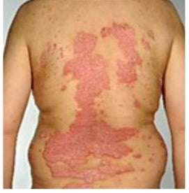 SkinMedix™ Natural Herbaceous Plants Psoriasis Cream - Image 16