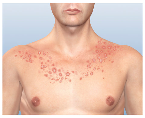 SkinMedix™ Natural Herbaceous Plants Psoriasis Cream - Image 15