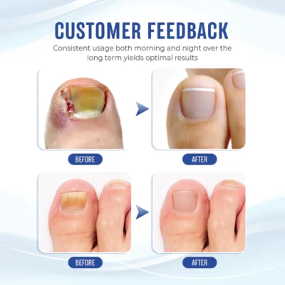 Biancat™ FungGone Herbal Paronychia Treatment Gel - Image 7