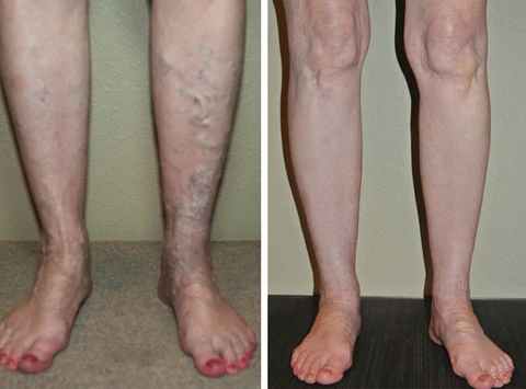 VeinFix Varicose Healing Spray - Image 6