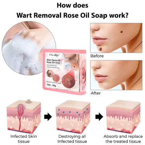 Oveallgo™ Wart NanoPURI Removal Rose Oil Soap - Image 4