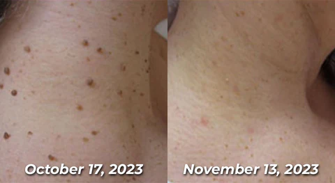 Seurico™ Bee Venom Power Mole & Wart Remover Spray - Image 9