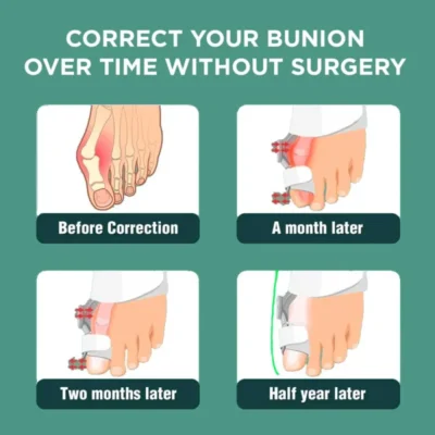 Gopura™ 3D Bunion Splint Corrector - Image 10