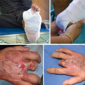 FLYCARE™ Diabetic Wounds Treatment Cream - Image 12