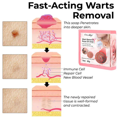 Oveallgo™ Wart NanoPURI Removal Rose Oil Soap - Image 3