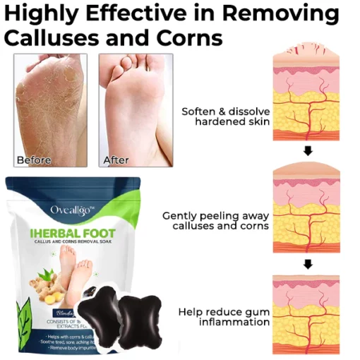 Oveallgo™ IHerbal Foot Callus And Corns Removal Soak - Image 4