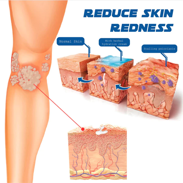 ATTDX Psoriasis Treatment BeeVenom Cream - Image 6