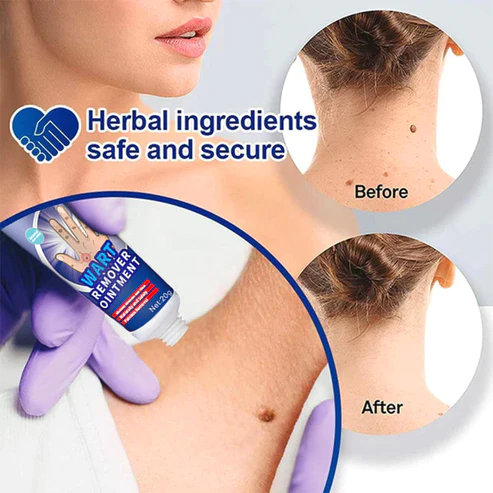 DermaEnd™ Wart Remover Herbal Ointment 100% Natural - Image 9