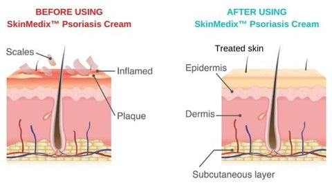 SkinMedix™ Natural Herbaceous Plants Psoriasis Cream - Image 13