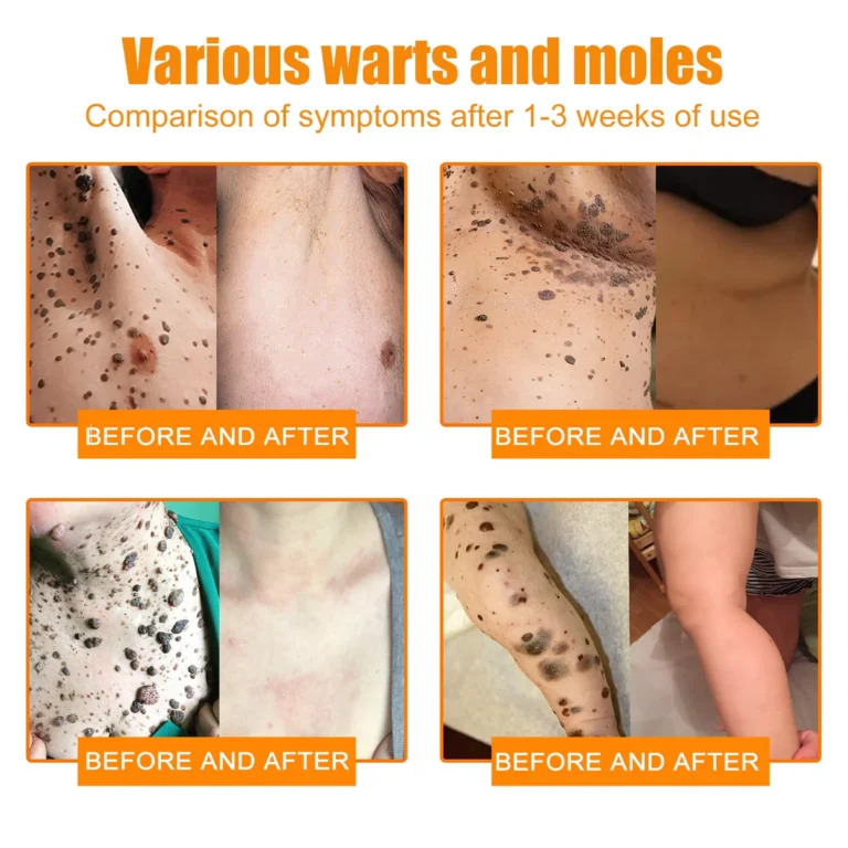 SEAGRIL™ Bee Venom Wart & Tag Removal Cream - Image 9