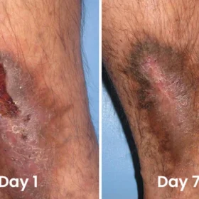 FLYCARE™ Diabetic Wounds Treatment Cream - Image 11