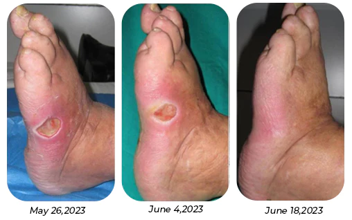 AQA™ SugarSync Health Control Aerosolizer - Image 9