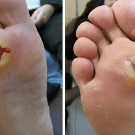 FLYCARE™ Diabetic Wounds Treatment Cream - Image 10