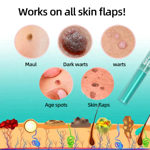 Biancat™Tags & Moles Remover - Image 5