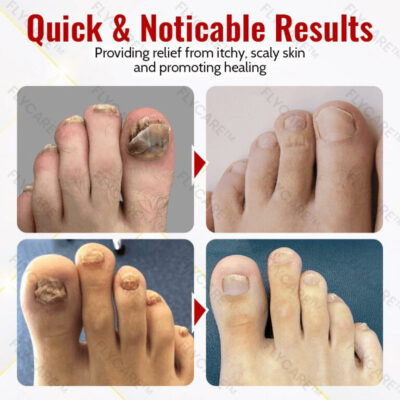 FLYCARE™ Anti-Fungus Relief Oil - Image 6