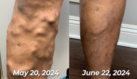 flysmus™ Varico-X Vein Dredge Bee Venom Spray - Image 18