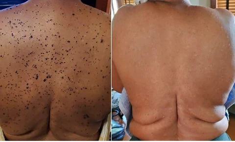 LOVILDS™ Tags & Moles Remover - Image 8