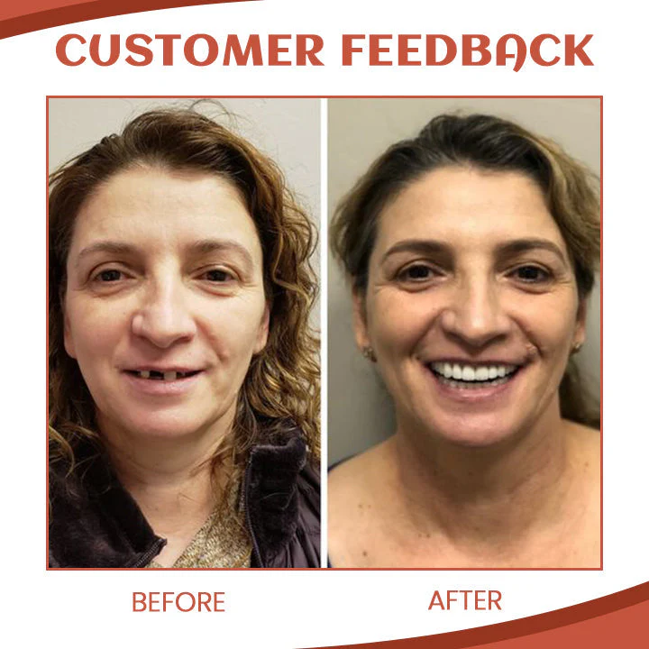 Dobshow™ PerfectFit Denture Silicone Reline Kit - Image 6