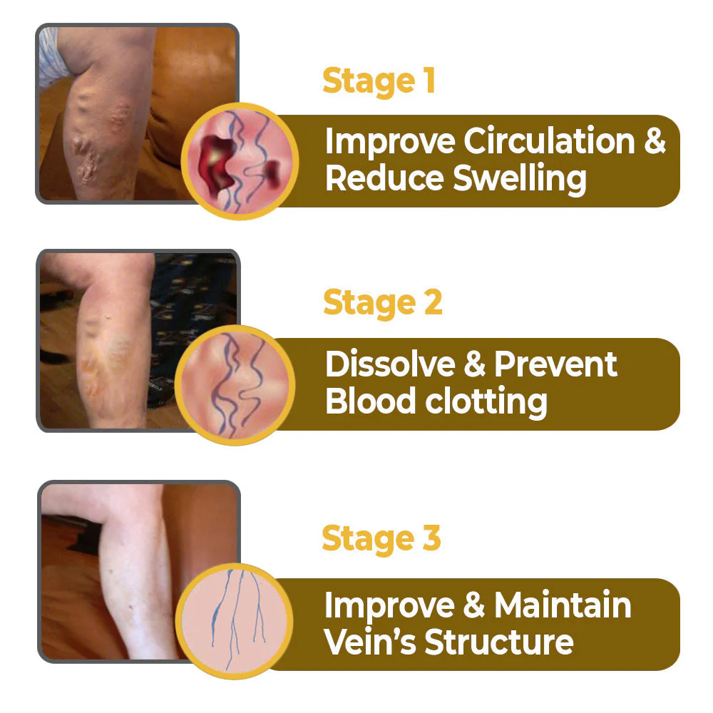 flysmus™ Varico-X Vein Dredge Bee Venom Spray - Image 17