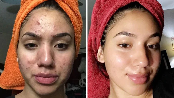 Ceoerty™ Nightly ClearSkin Patch - Image 7